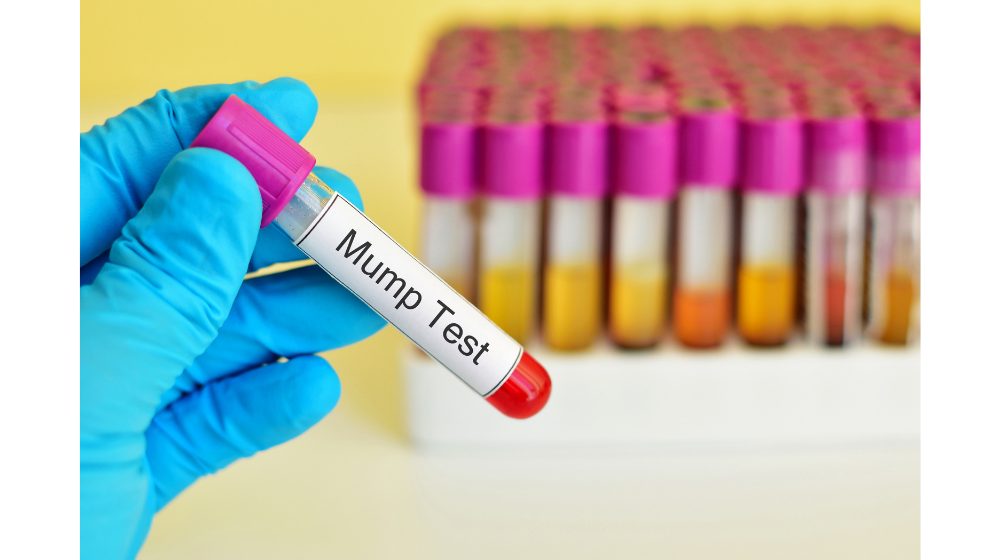 おたふく風邪は大人でもかかる?熱が出ないケースもある?