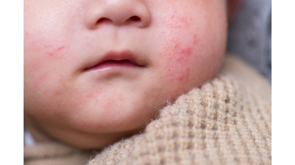 子どもが汗疹(あせも)になったときはどうすればいい？治し方や湿疹との違い・対策法について